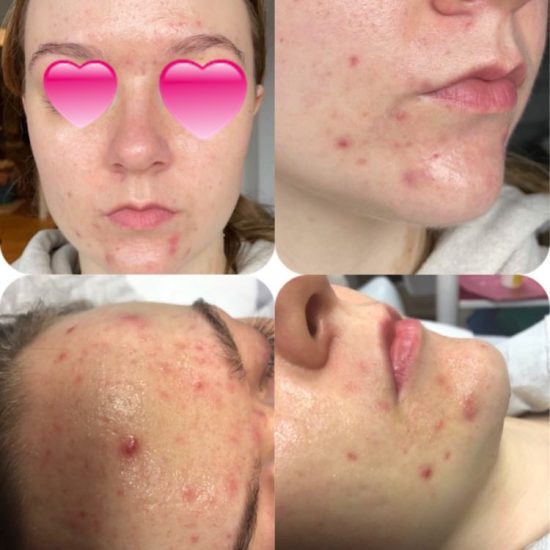 Terapia fotodynamiczna Foto Żel estGenok