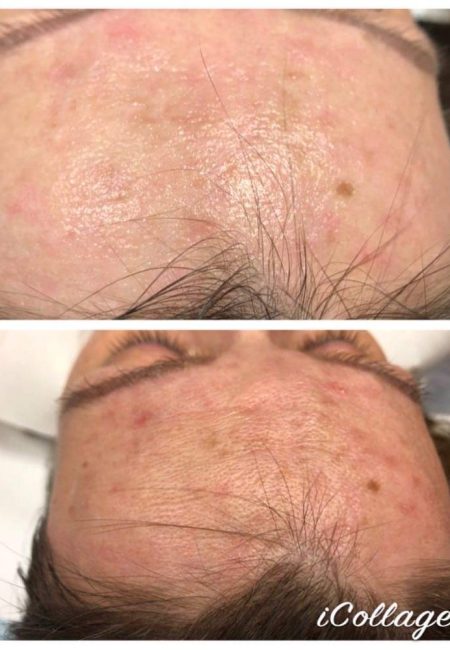 efekty po zabiegach estGen