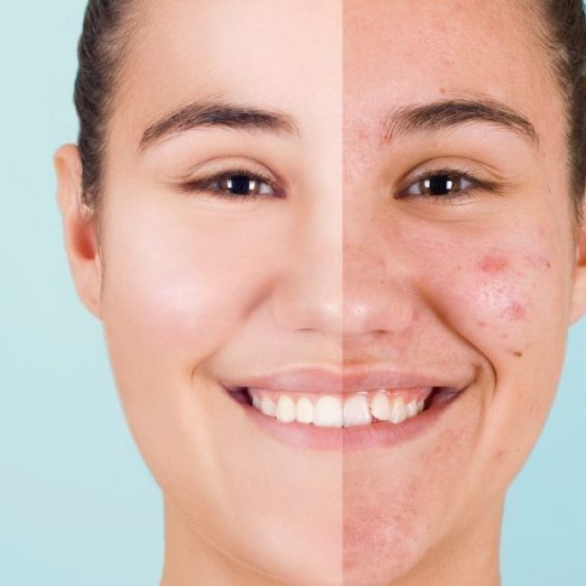 tradzik zabiegi skuteczne (1)