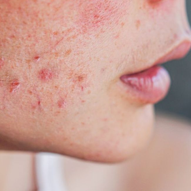 tradzik zabiegi skuteczne