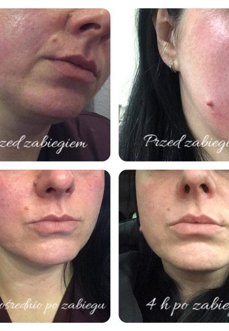 zabieg est gen efekty